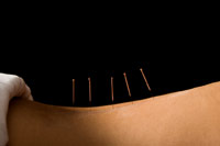 acupuncture of the lower back