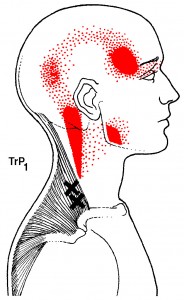 Referred pain and trigger points for the trapezius.