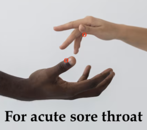 two hands, one with dark skin, one light skinned. Both have a red dot at the outer edge of the base of the thumbnail. Text says "for acute sore throat"